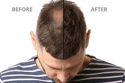 First Global Clinic -Hair Loss Treatment